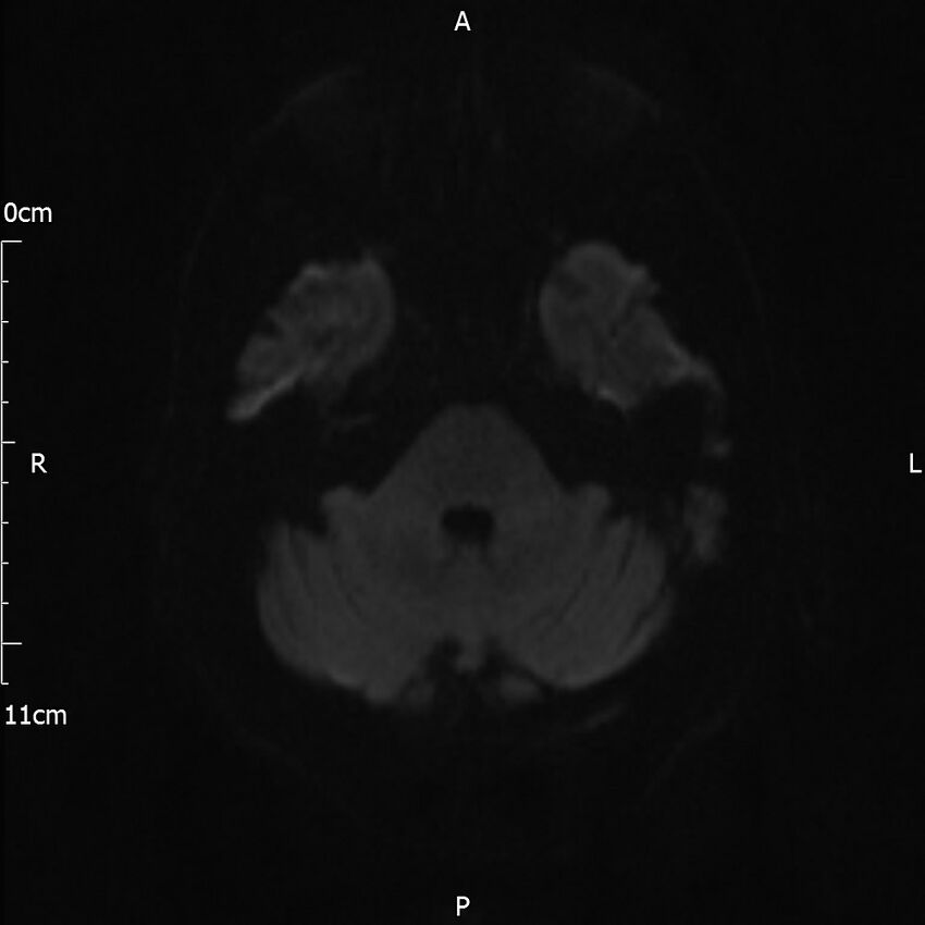 Cerebral amyloid angiopathy related inflammation (Radiopaedia 72772-83415 Axial DWI 53).jpg