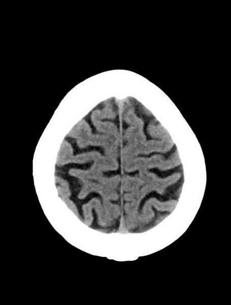 File:Cerebral aneurysm with rupture (Radiopaedia 29933-30457 Axial non-contrast 23).jpg