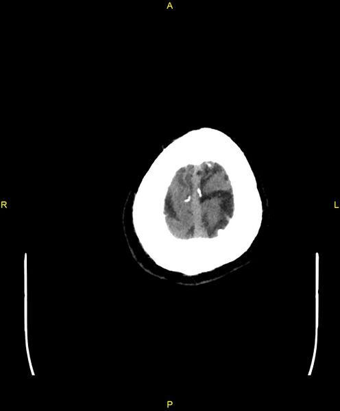 File:Cerebral autosomal dominant arteriopathy with subcortical infarcts and leukoencephalopathy (CADASIL) (Radiopaedia 86108-102051 Axial non-contrast 109).jpg