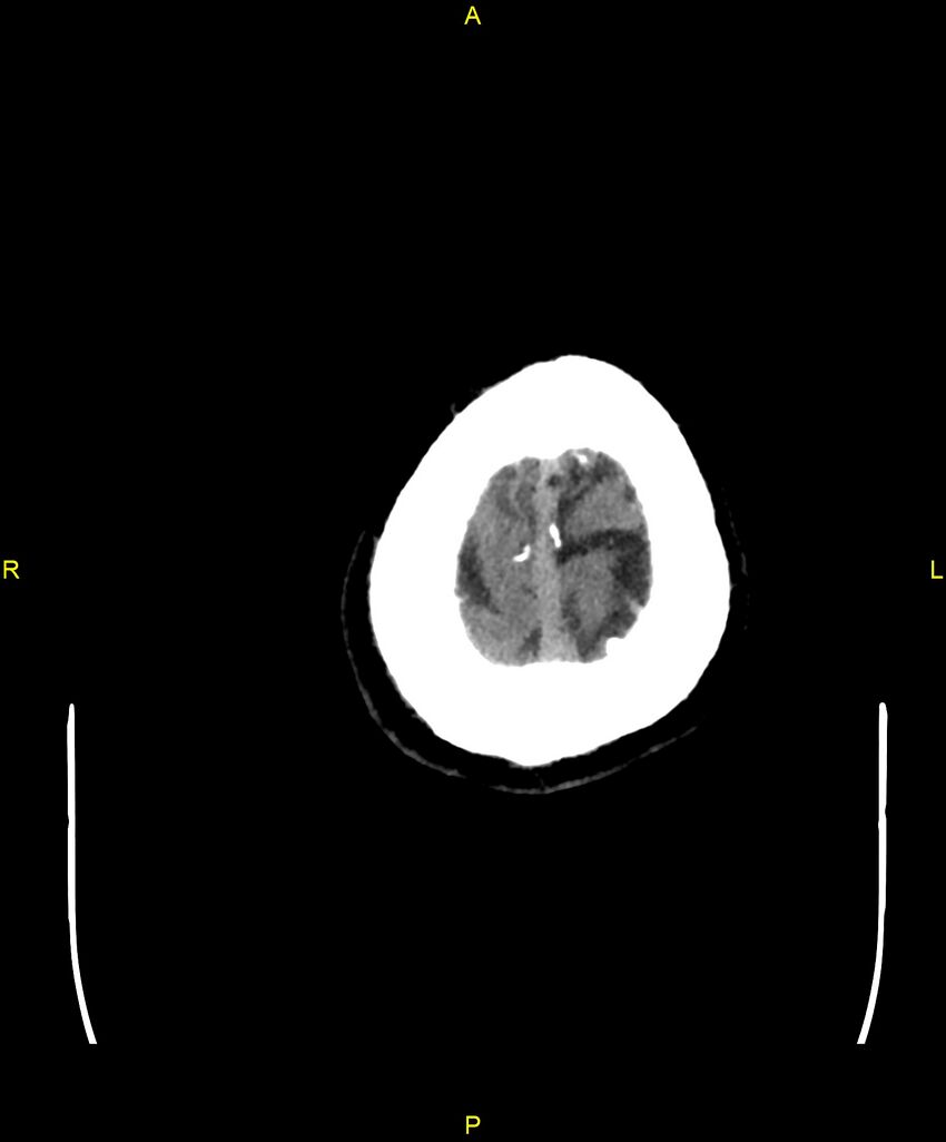 Cerebral autosomal dominant arteriopathy with subcortical infarcts and leukoencephalopathy (CADASIL) (Radiopaedia 86108-102051 Axial non-contrast 109).jpg