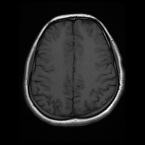 File:Cerebral cavernous malformation (Radiopaedia 44301-47942 Axial T1 15).jpg