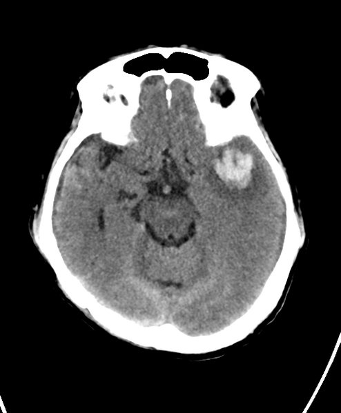 File:Cerebral contusions, subarachnoid hemorrhage and subdural hygromas (Radiopaedia 55399-61828 Axial non-contrast 11).png