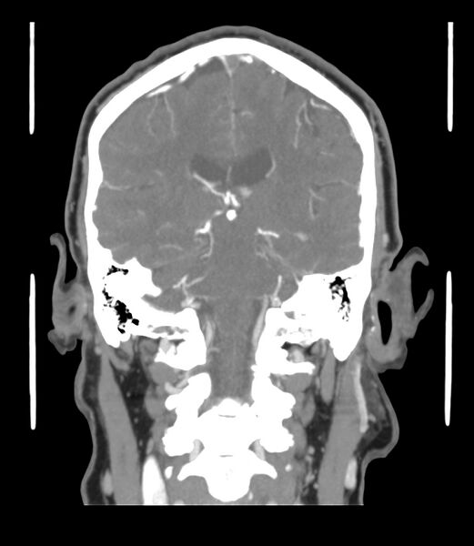 File:Cerebral dural venous sinus thrombosis (Radiopaedia 86514-102576 B 43).jpg