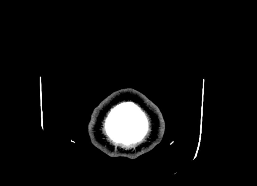 Cerebral edema (Radiopaedia 82519-96661 Axial non-contrast 1).jpg