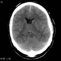 Cerebral hemorrhagic contusion with subdural and subarachnoid hemorrhage (Radiopaedia 10680-19197 Axial non-contrast 11).jpg