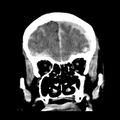Cerebral hemorrhagic contusions (Radiopaedia 23145-23188 Coronal non-contrast 11).jpg
