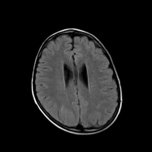 File:Cerebral tuberculoma (Radiopaedia 41152-43932 Axial FLAIR 15).jpg