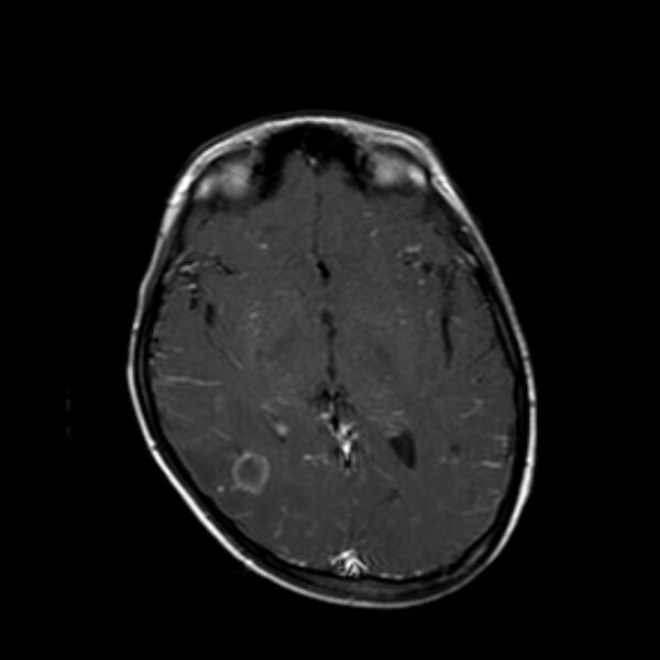 File:Cerebral tuberculoma (Radiopaedia 41152-43932 Axial T1 C+ 11).jpg