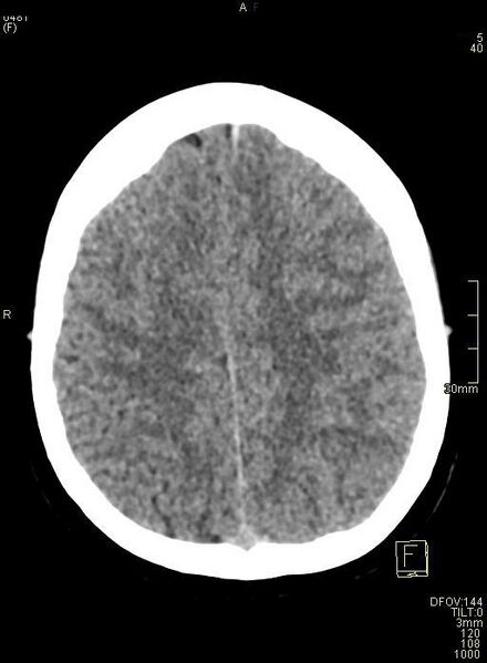File:Cerebral venous sinus thrombosis (Radiopaedia 91329-108965 Axial non-contrast 38).jpg
