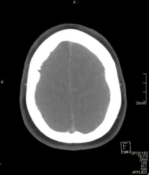 File:Cerebral venous sinus thrombosis (Radiopaedia 91329-108965 Axial venogram 68).jpg