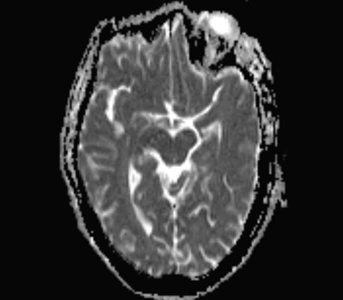File:Cerebral venous thrombosis (Radiopaedia 71207-81504 Axial ADC 8).jpg