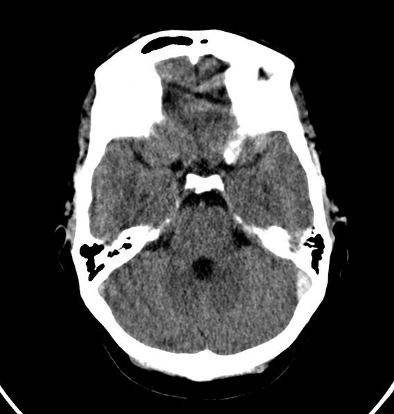 File:Cerebral venous thrombosis - CT only (Radiopaedia 41031-43778 Axial non-contrast 60).jpg