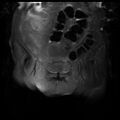 Cervical carcinoma (Radiopaedia 78847-91705 Coronal T2 fat sat 3).jpg