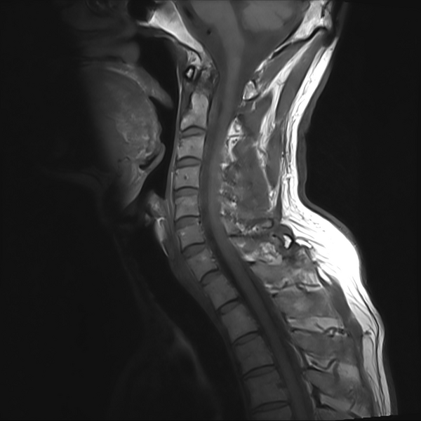File:Cervical dural CSF leak on MRI and CT treated by blood patch (Radiopaedia 49748-54995 Sagittal T1 6).png