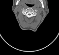 Cervical dural CSF leak on MRI and CT treated by blood patch (Radiopaedia 49748-54996 B 25).png