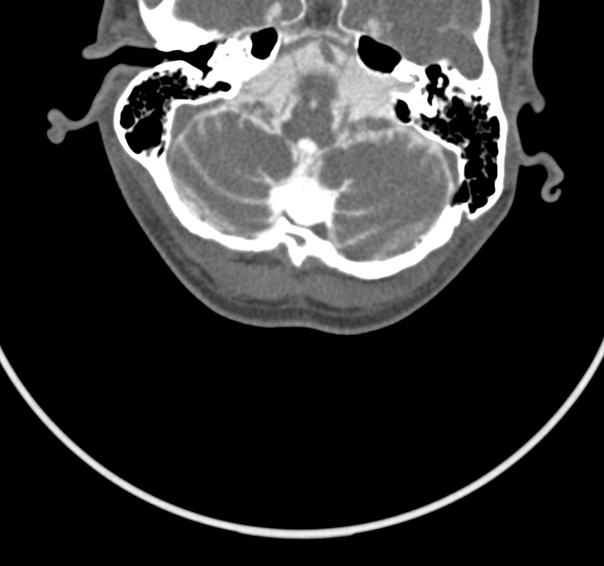 Cervical dural CSF leak on MRI and CT treated by blood patch (Radiopaedia 49748-54996 B 5).png
