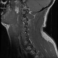 Cervical flexion teardrop fracture with cord hemorrhage (Radiopaedia 32497-33455 Sagittal T1 2).jpg
