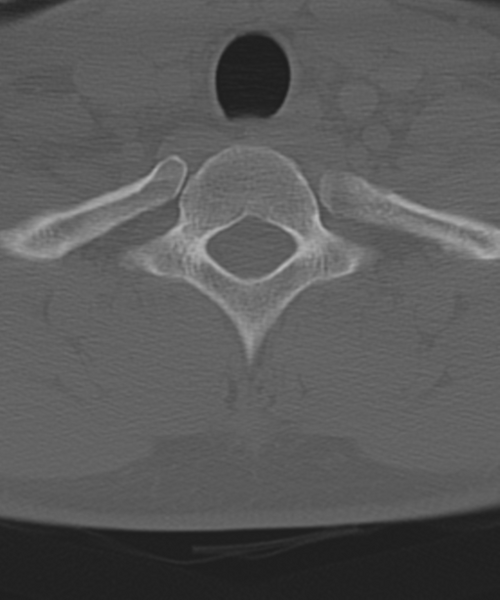 File:Cervical intercalary bone (Radiopaedia 35211-36748 Axial bone window 57).png