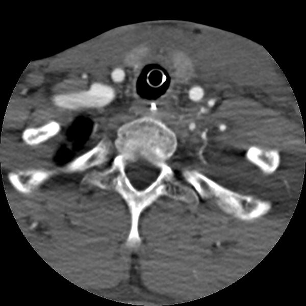 File:Cervical spine fractures with vertebral artery dissection (Radiopaedia 32135-33078 D 20).jpg