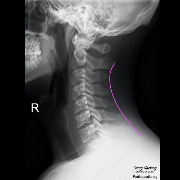 File:Cervical spine lines (Radiopaedia 76069-87571 I 1).jpeg