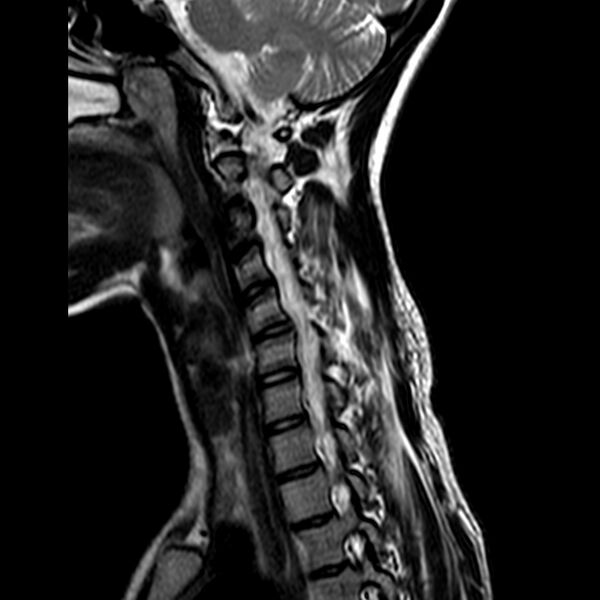 File:Cervical spine posterior ligamentous complex rupture (Radiopaedia 63486-72103 Sagittal T2 4).jpg