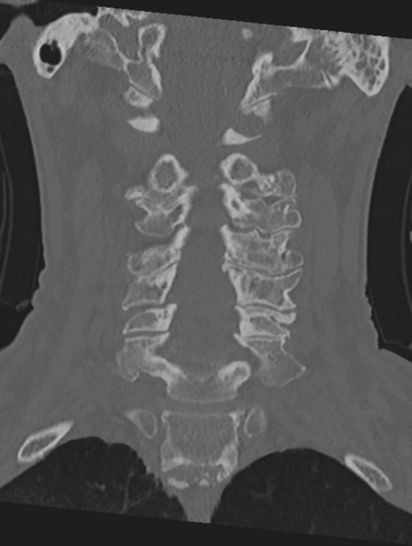 File:Cervical spondylolysis (Radiopaedia 49616-54811 Coronal bone window 26).png