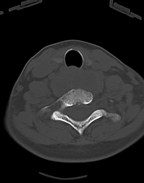 File:Cervical tuberculous spondylitis (Radiopaedia 39149-41365 Axial bone window 41).png