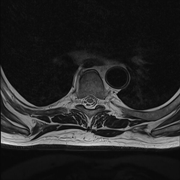 File:Cervical tumor-like myelopathy due to Type V dAVF (Radiopaedia 82461-96604 D 20).jpg