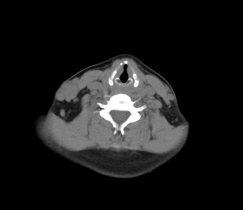 Cervical venous malformation (Radiopaedia 22653-22672 Axial non-contrast 38).jpg