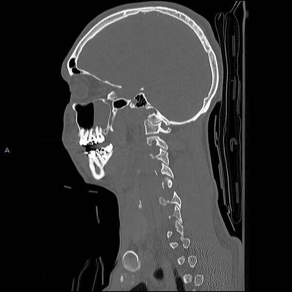 File:Cervical vertebral burst fracture (Radiopaedia 37420-39258 Sagittal bone window 5).jpg