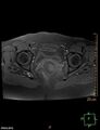 Cesarian scar endometriosis (Radiopaedia 68495-78066 Axial T1 fat sat 18).jpg