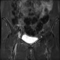 Cesarian section scar endometriosis (Radiopaedia 66520-75799 Coronal STIR 10).jpg