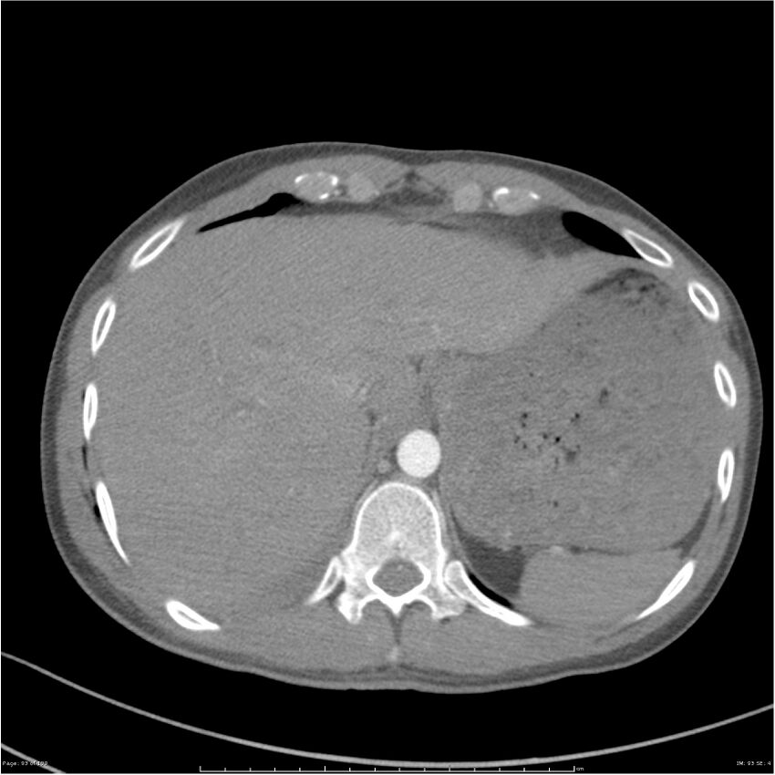 Chest and abdomen multi-trauma (Radiopaedia 26294-26425 A 93).jpg