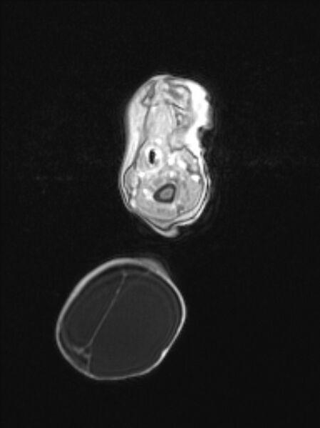 File:Chiari III malformation with occipital encephalocele (Radiopaedia 79446-92559 Axial T1 C+ mpr 18).jpg