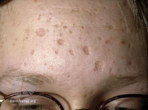 Chickenpox scars (DermNet NZ dermal-infiltrative-s-chickenpox-scars).jpg