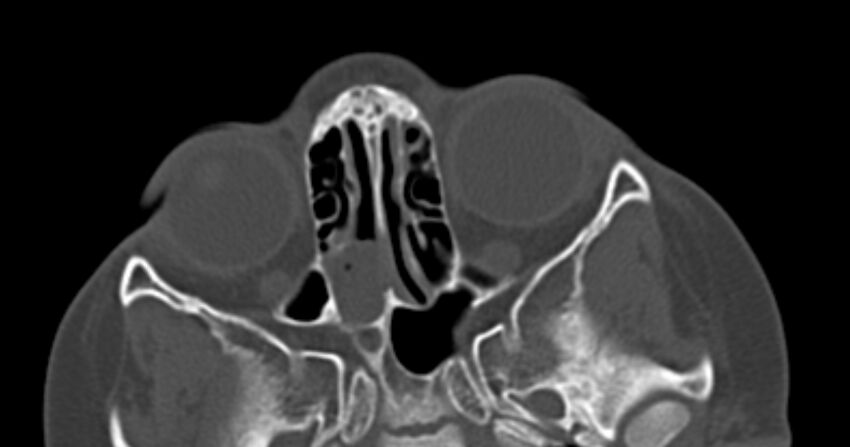 Choanal atresia (Radiopaedia 51295-56972 Axial bone window 38).jpg