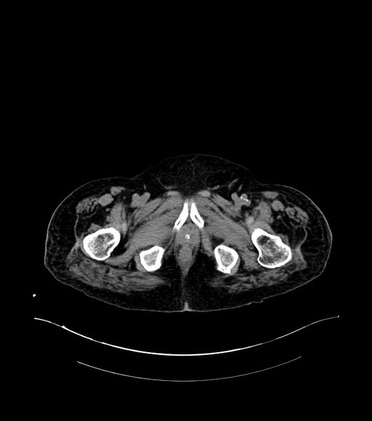 File:Cholangiocarcinoma with cerebral metastases (Radiopaedia 83519-98629 Axial non-contrast 131).jpg