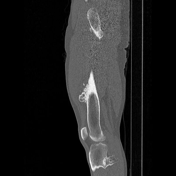 File:Chondrosarcoma arising from exostosis (Radiopaedia 59996-67507 Sagittal bone window 4).jpg