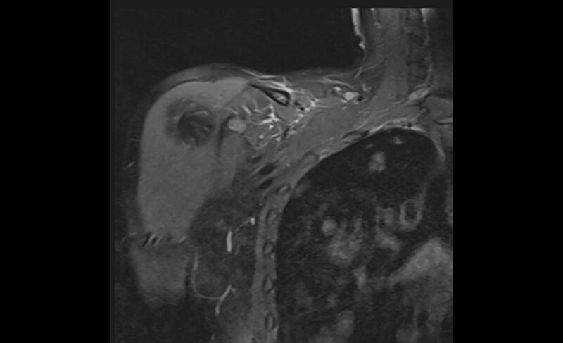 File:Choriocarcinoma in the shoulder (Radiopaedia 28603-28861 Coronal PD FS 3).jpg