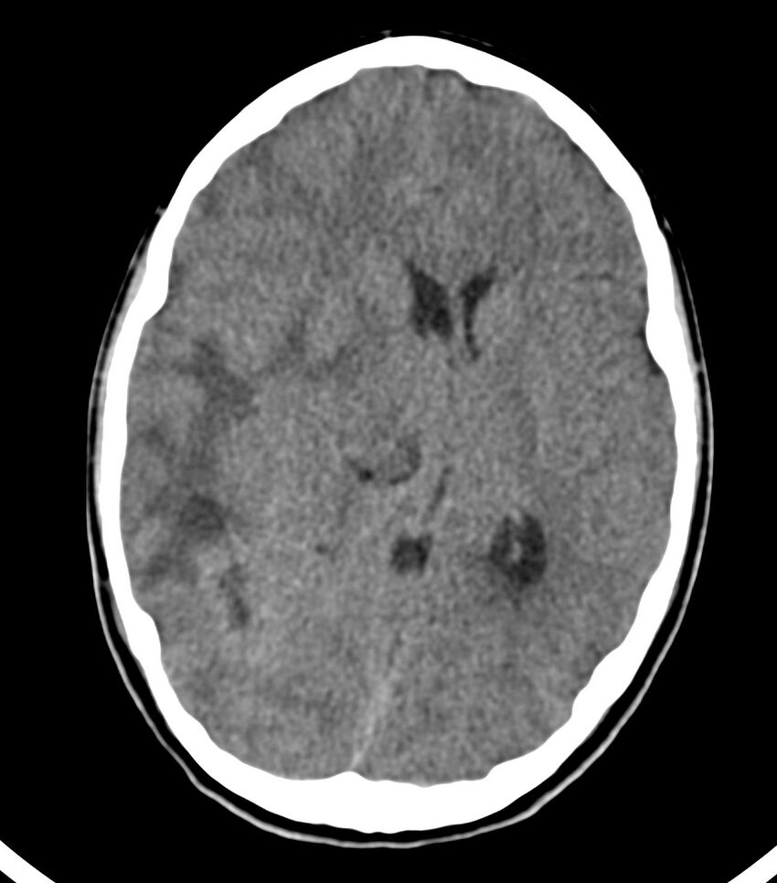 Choroid plexus carcinoma (Radiopaedia 91013-108552 Axial non-contrast 31).jpg