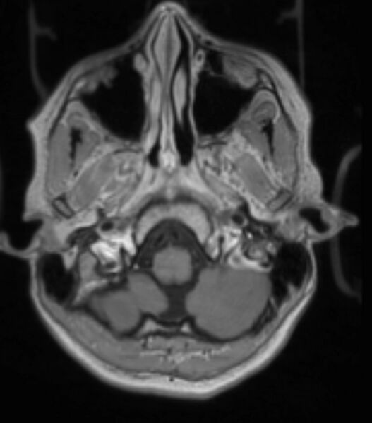 File:Choroid plexus carcinoma (Radiopaedia 91013-108553 Axial T1 C+ 82).jpg
