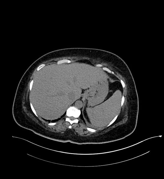 File:Chromophobe renal cell carcinoma (Radiopaedia 84239-99519 Axial non-contrast 37).jpg