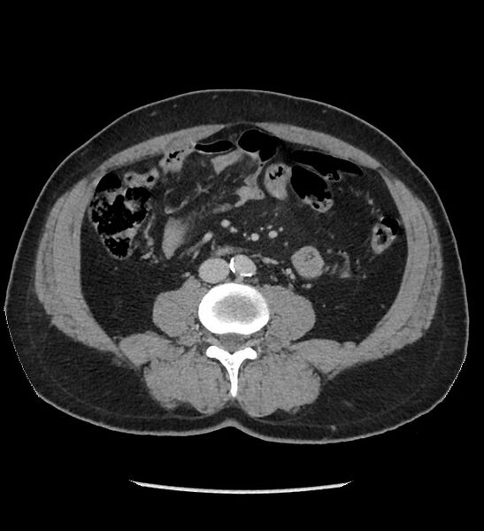 File:Chromophobe renal cell carcinoma (Radiopaedia 86879-103083 C 83).jpg