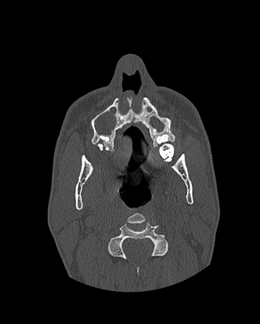 Chronic maxillary sinusitis caused by a foreign body (Radiopaedia 58521-65676 Axial bone window 53).jpg