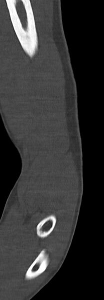 File:Chronic osteomyelitis of the distal humerus (Radiopaedia 78351-90971 Sagittal bone window 37).jpg