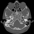 Chronic otomastoiditis (Radiopaedia 27138-27309 Axial bone window 16).jpg