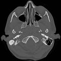 Chronic otomastoiditis (Radiopaedia 27138-27309 Axial bone window 4).jpg