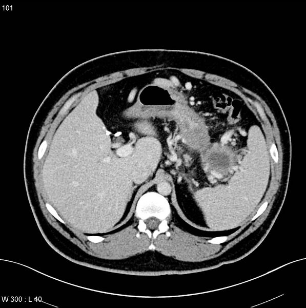File:Chronic pancreatitis and pseudocysts (Radiopaedia 6724-7935 D 2).jpg