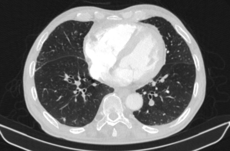 File:Chronic pulmonary embolism (Radiopaedia 91241-108843 Axial lung window 63).jpg