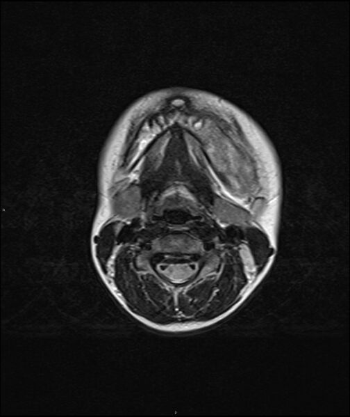 File:Chronic reactive multifocal osteomyelitis (CRMO) - mandible (Radiopaedia 56405-63069 Axial T2 6).jpg